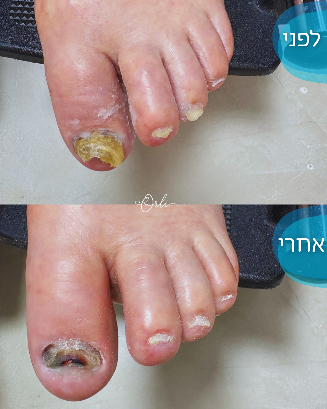 עבודה אמיתית בכף הרגל — לפני ואחרי